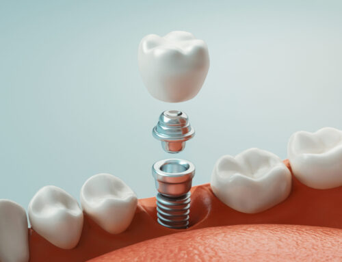 Dental Implants vs. Dentures: Choosing Your Smile Solution