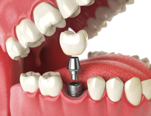 Navigating Dental Implant Options: Your Smile Guide