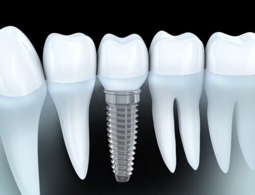 Can Dental Implants Get Cavities? The Truth Revealed