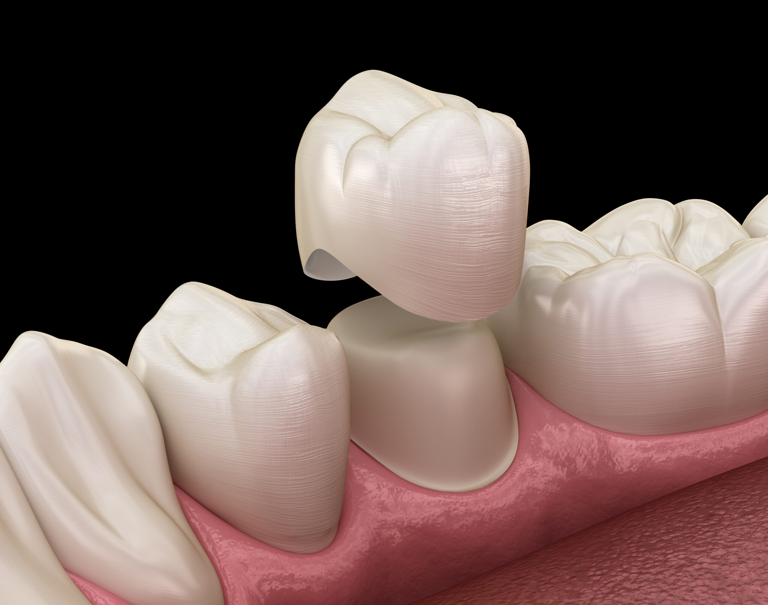 Dental crown premolar tooth assembly process. Medically accurate 3D illustration of a dental crown being placed over a prepared tooth for crown and bridgework restoration at The Center for Complete Healthy Dentistry in Wilton, CT